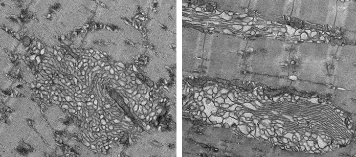 Image of tubular aggregates in Mythodepleted skeletal muscle using transmission electron microscopy. Tubular aggregates are often found in muscle disorders. Image: Jean-Philippe Leduc-Gaudet