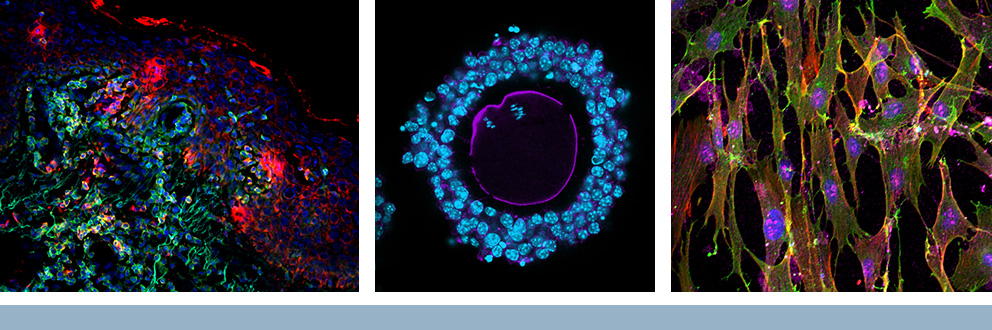Imagerie cellulaire des laboratoires des chercheurs de l'IR-CUSM Carolyn Jack, M.D., Ph. D. (distribution des cellules immunitaires et production de cytokines IL-13 dans la peau des patients atteints d'eczéma), Hugh Clarke, Ph. D. (complexe granulosa-ovocyte) et Lorenzo Ferri, M.D., Ph. D. (identification de marqueurs tumoraux dans les fibroblastes cancéreux). Images réalisées à la Plateforme d’imagerie moléculaire de l’IR-CUSM.