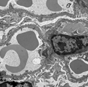 Electron microscopy picture of a normal kidney podocyte. Photo: Andrey Cybulsky